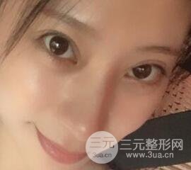 成都嬌點(diǎn)李競割雙眼皮價(jià)格和案例