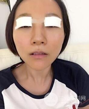 武漢葉子竺湘云給我做的切開雙眼皮手術，分享一下前后對比圖片