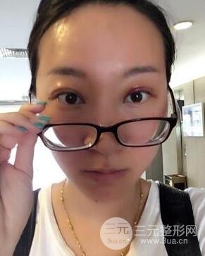武漢葉子竺湘云給我做的切開雙眼皮手術，分享一下前后對比圖片