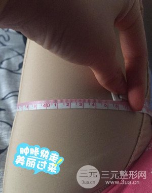 大腿吸脂前后對比圖以及恢復過程分享——武漢葉子竺湘云醫(yī)生做的