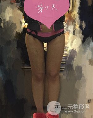 大腿吸脂前后對比圖以及恢復過程分享——武漢葉子竺湘云醫(yī)生做的