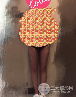 大腿吸脂前后對比圖以及恢復過程分享——武漢葉子竺湘云醫(yī)生做的