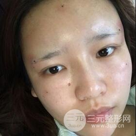 成都嬌點(diǎn)整容醫(yī)院李競做全臉脂肪填充案例