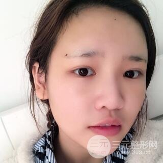 成都嬌點(diǎn)整容醫(yī)院李競做全臉脂肪填充案例