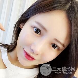 成都嬌點(diǎn)整容醫(yī)院李競做全臉脂肪填充案例