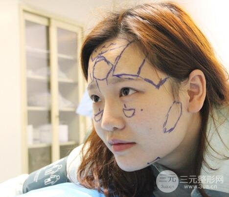 成都嬌點(diǎn)整容醫(yī)院李競做全臉脂肪填充案例