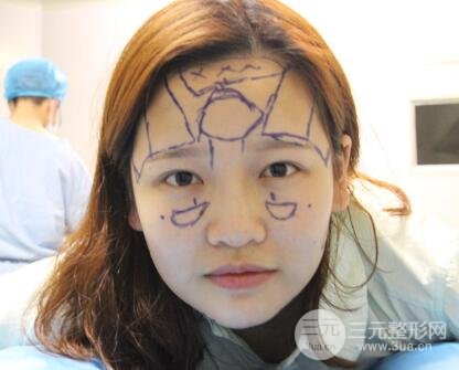 成都嬌點(diǎn)整容醫(yī)院李競做全臉脂肪填充案例