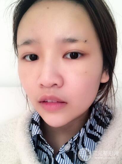成都嬌點(diǎn)整容醫(yī)院李競做全臉脂肪填充案例