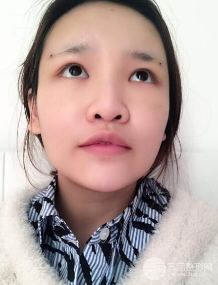 成都嬌點(diǎn)整容醫(yī)院李競做全臉脂肪填充案例