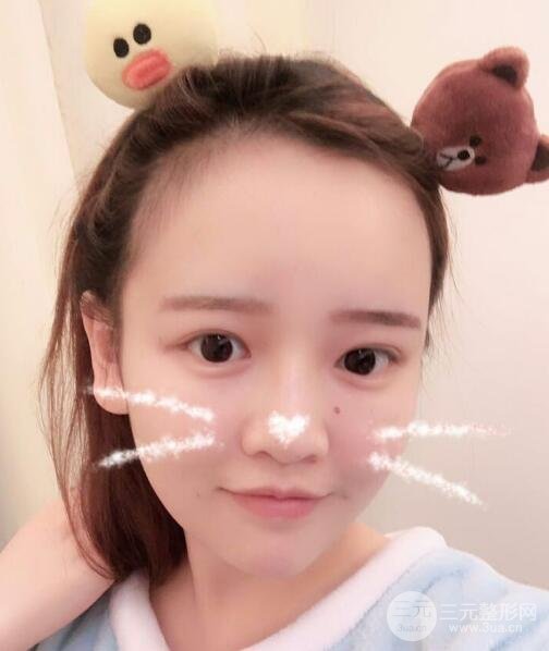成都嬌點(diǎn)整容醫(yī)院李競做全臉脂肪填充案例