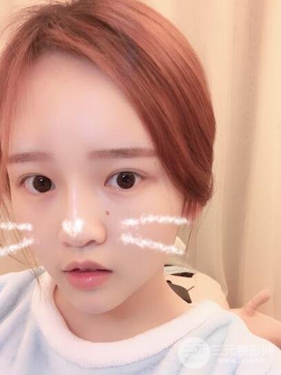 成都嬌點(diǎn)整容醫(yī)院李競做全臉脂肪填充案例