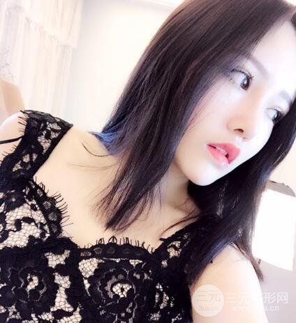 成都嬌點(diǎn)整容醫(yī)院李競做全臉脂肪填充案例