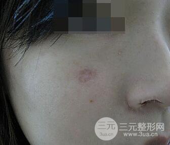 激光祛疤非手術真實果圖案例