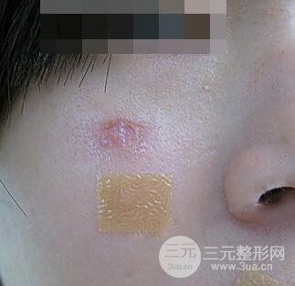 激光祛疤非手術真實果圖案例