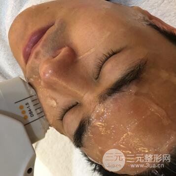 男士高強度聚焦超聲面b提升微整形真實案例