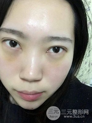 內(nèi)切祛眼袋手術(shù)真實(shí)案例，武漢天申胡麗醫(yī)生做的