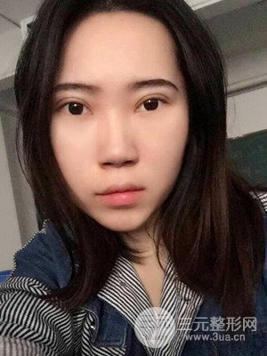 內(nèi)切祛眼袋手術(shù)真實(shí)案例，武漢天申胡麗醫(yī)生做的
