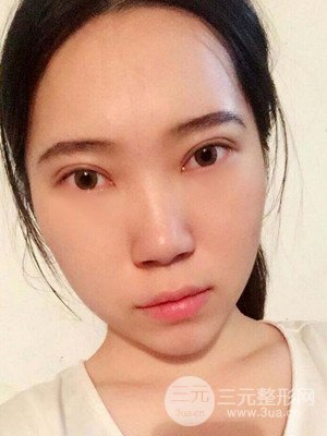內(nèi)切祛眼袋手術(shù)真實(shí)案例，武漢天申胡麗醫(yī)生做的