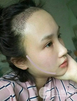 武漢天申胡麗醫(yī)生發(fā)際線種植真實(shí)案例，并附上前后對(duì)比圖片