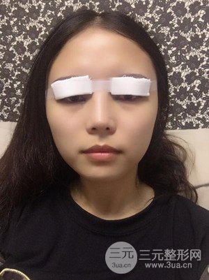 　全切雙眼皮真實(shí)案例分享，武漢一美汪國民醫(yī)生做的