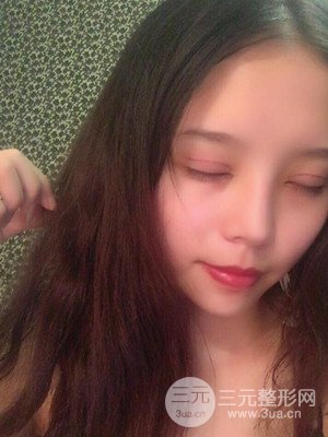 　全切雙眼皮真實(shí)案例分享，武漢一美汪國民醫(yī)生做的