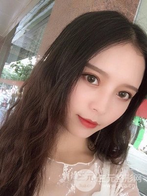 　全切雙眼皮真實(shí)案例分享，武漢一美汪國民醫(yī)生做的