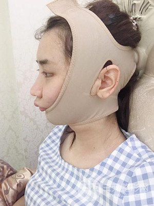 武漢一美汪國民醫(yī)生做的面部吸脂【案例】，分享一下前后對比圖片