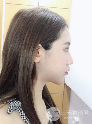 武漢一美汪國民醫(yī)生做的面部吸脂【案例】，分享一下前后對比圖片