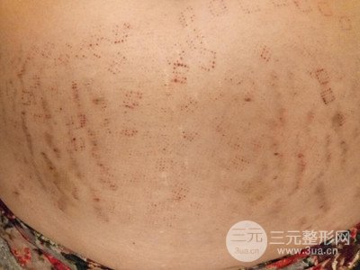 武漢一美王朝暉激光去妊娠紋真實案例，并附上前后對比圖片