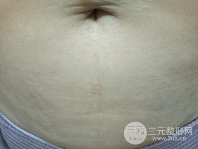 武漢一美王朝暉激光去妊娠紋真實案例，并附上前后對比圖片