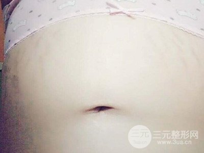 武漢一美王朝暉激光去妊娠紋真實案例，并附上前后對比圖片