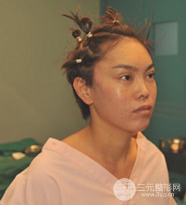 去做了埋線面b提拉術果很是不錯