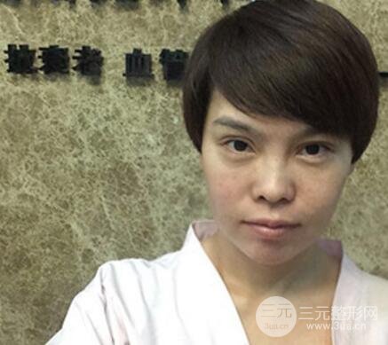 去做了埋線面b提拉術果很是不錯