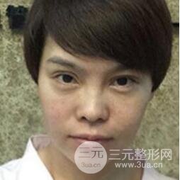 去做了埋線面b提拉術(shù)果很是不錯