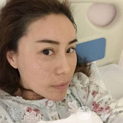 武漢美侖陳遠(yuǎn)海自體脂肪填充全臉案例，附上前后對比圖片