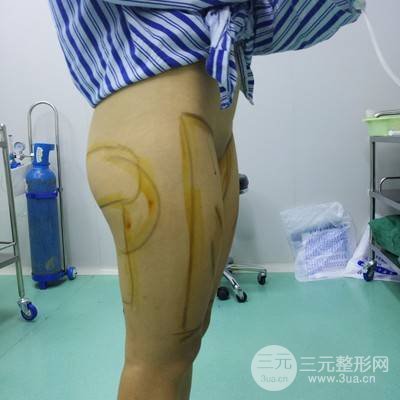武漢美侖陳遠海醫(yī)生做的大腿吸脂案例，分享一下前后對比圖