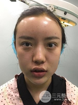 自體脂肪填充額頭+豐下巴真實案例，昆明都市儷人金海坤醫(yī)生做的