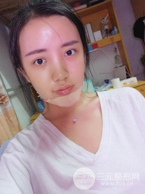 自體脂肪填充額頭+豐下巴真實案例，昆明都市儷人金海坤醫(yī)生做的