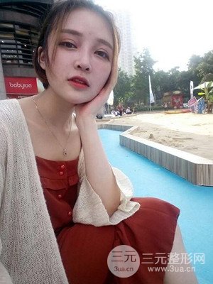 切開雙眼皮+假體隆鼻案例，前后對比圖分享