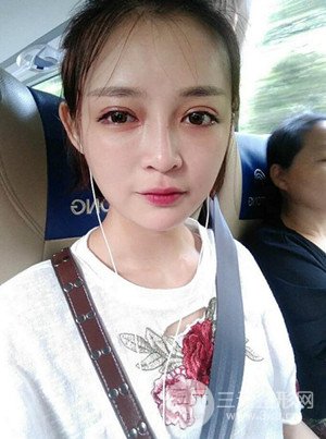 切開雙眼皮+假體隆鼻案例，前后對比圖分享