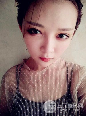 切開雙眼皮+假體隆鼻案例，前后對比圖分享