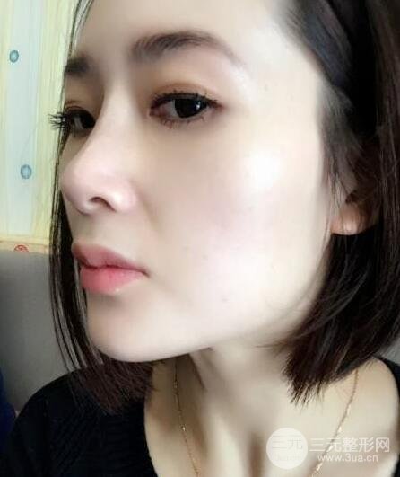 打完鼻子恢復(fù)的過程圖，隆鼻案例日記分享