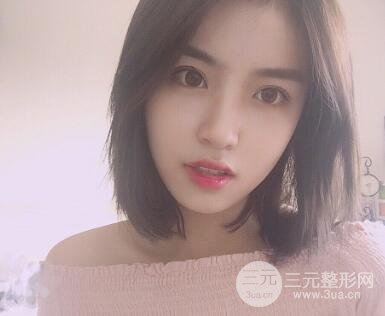 南京康美陳小劍做的雙眼皮案例果真實的分享給你們！