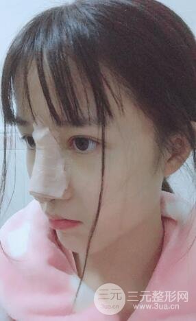 柏麗李勁良假體隆鼻案例果分享！小巧精致又立體~
