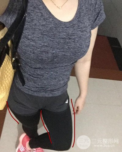 上海九院張余光大腿吸脂+臀部吸脂，恢復過程案例分享~