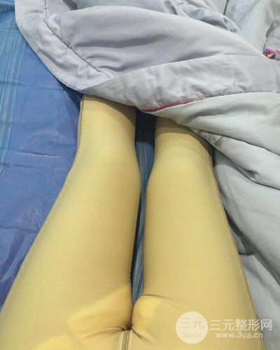上海九院張余光大腿吸脂+臀部吸脂，恢復(fù)過程案例分享~
