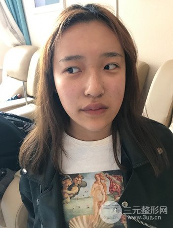 上海面部脂肪填充一個(gè)月果超明X、妥妥減齡十歲！