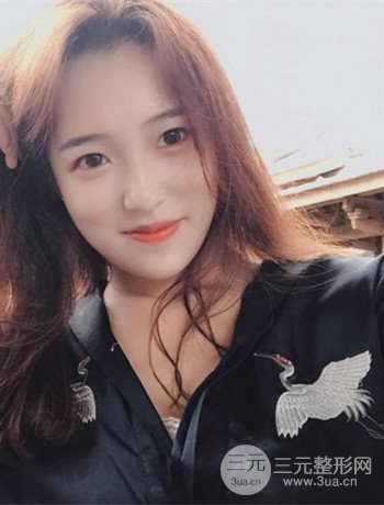 上海面部脂肪填充一個(gè)月果超明X、妥妥減齡十歲！