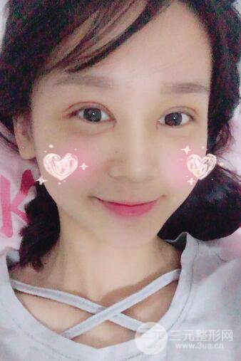 芭比電雙眼皮多項(xiàng)整形術(shù)后分享，雙眼皮拯救死魚眼！