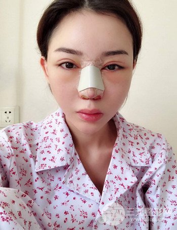 上海隆鼻失敗手術(shù)修復(fù)果超乎想象、前后對(duì)比照片分享